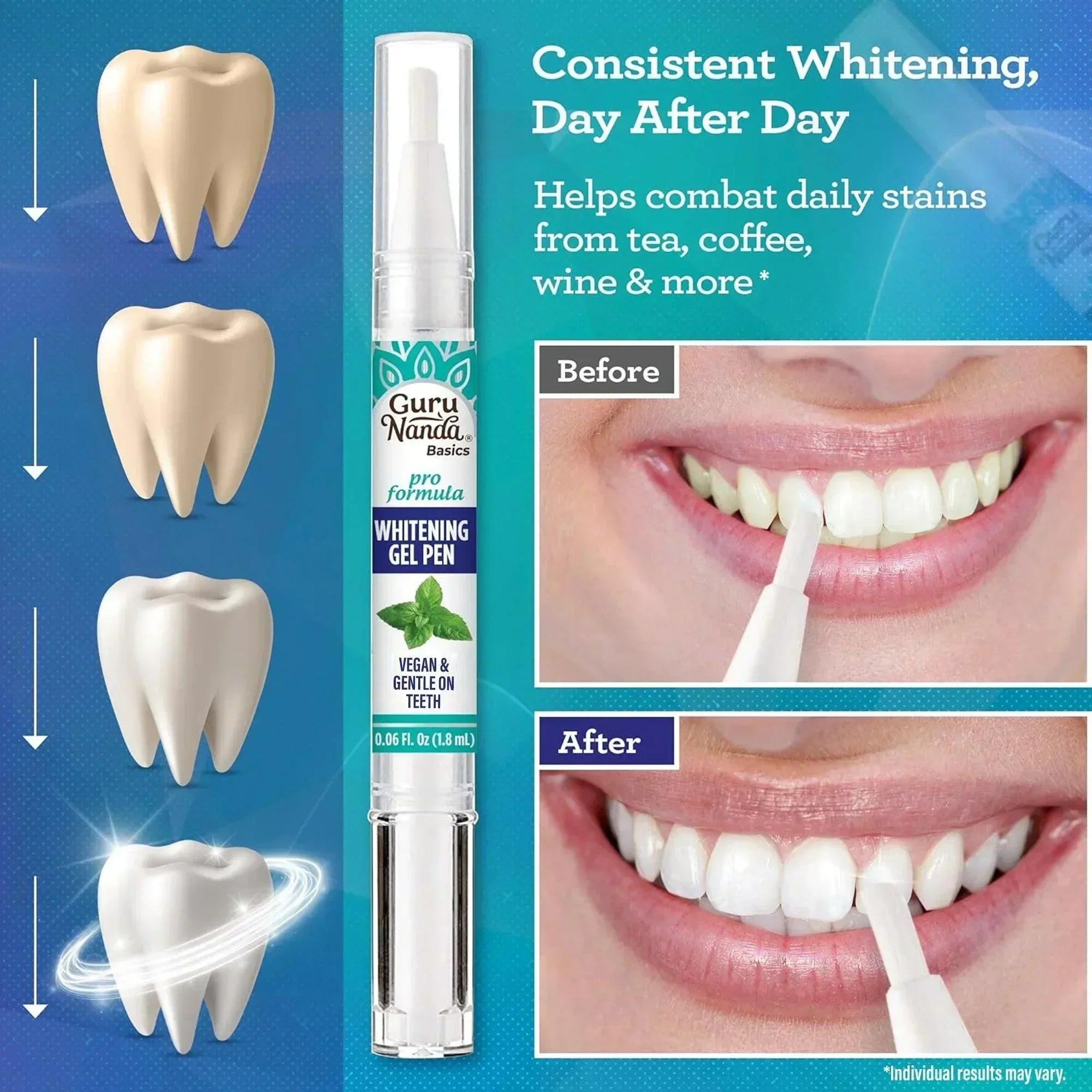 GuruNanda Whitening Gel Pen before and after results, showing consistent tooth shade improvement and stain removal from tea, coffee, and wine